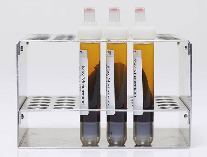 Autologous Conditioned Serum